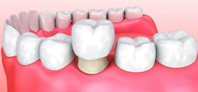 Corona dental de zirconia