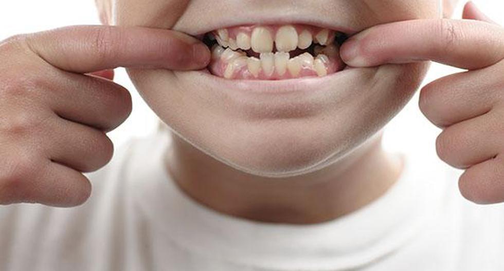 BLOG What is the minimum age for braces in children?
