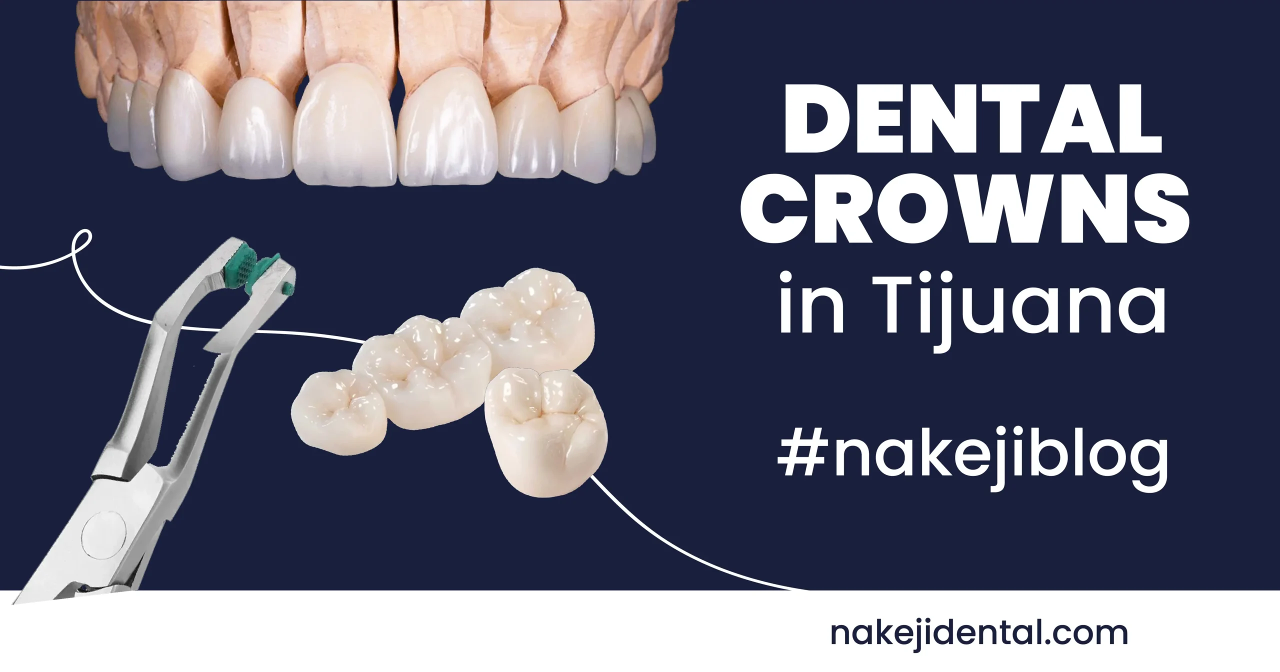 coronas-dentales-tijuana-nakeji-dental