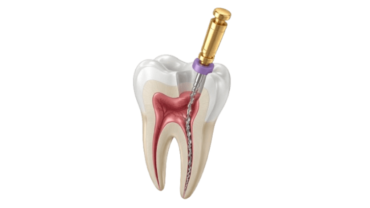 Endodoncias