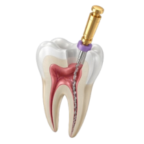 endodoncia