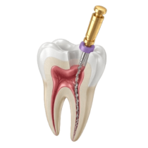 endodoncia