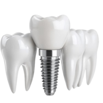 implantes